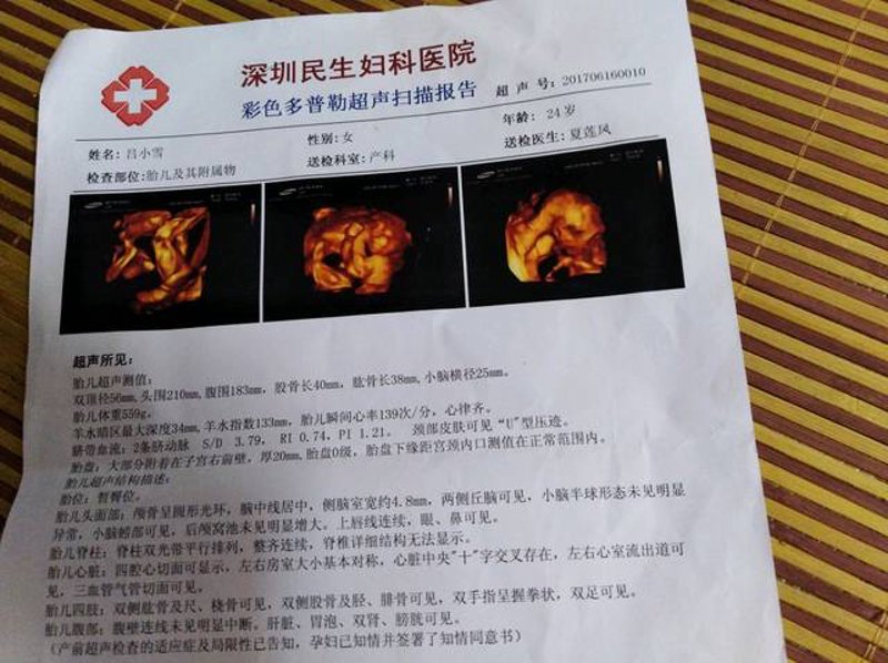 四维彩超